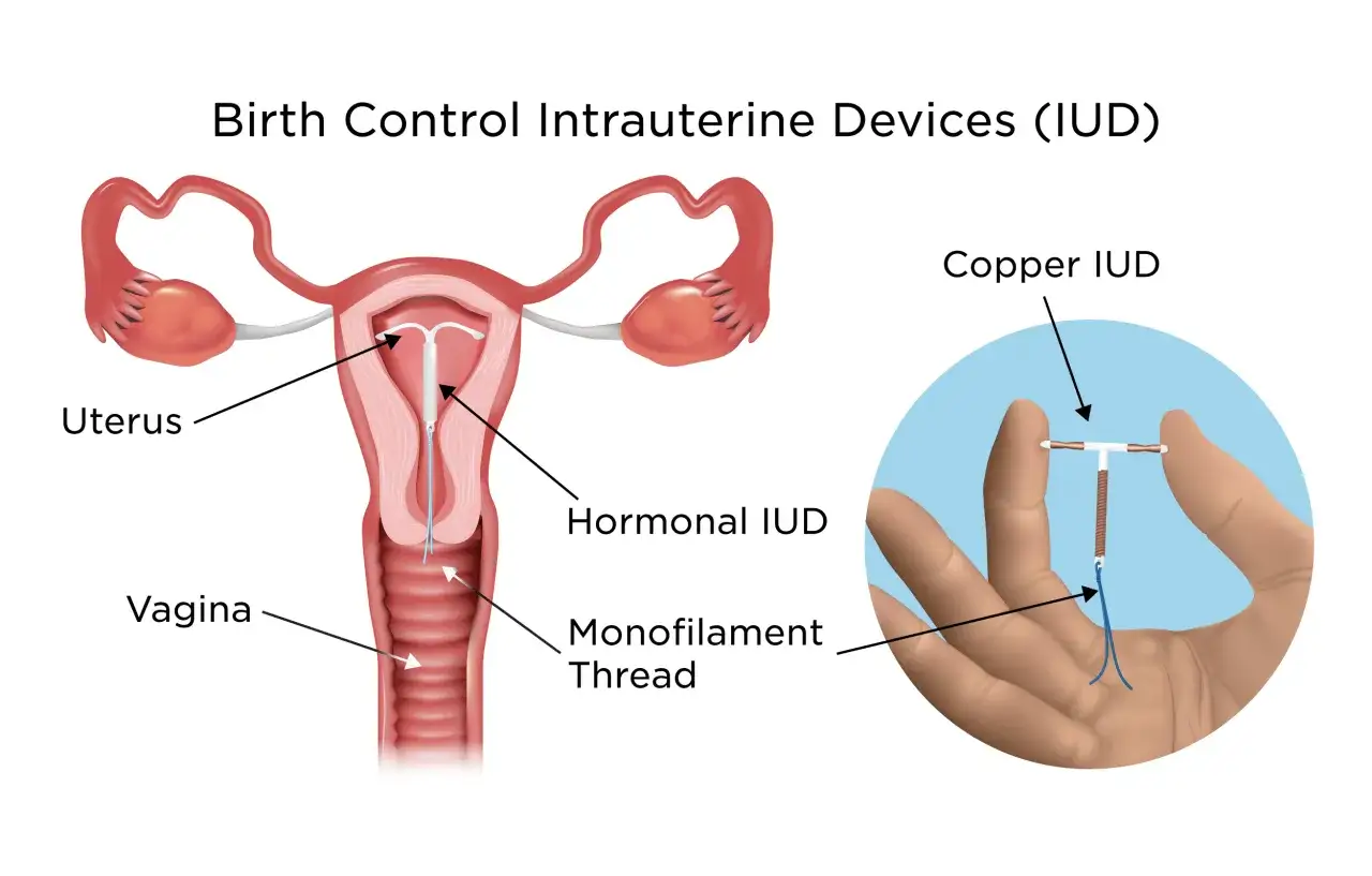 Sch&eacute;ma de l'ut&eacute;rus et du vagin montrant un st&eacute;rilet cuivre, une option contraceptive qui n'affecte pas le libido.